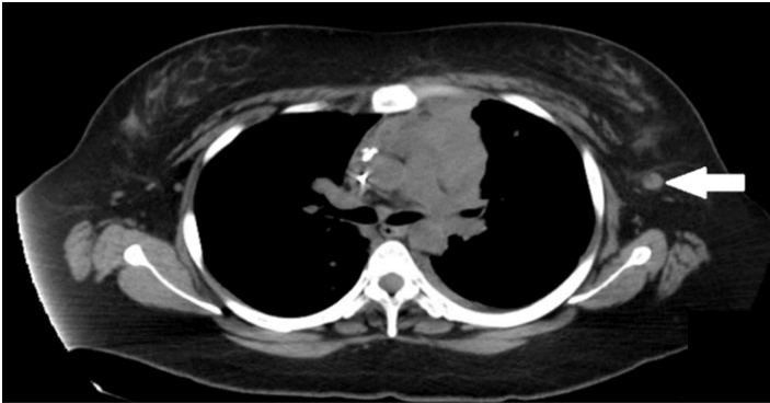 Single-Dose Pembrolizumab Achieving Remission in Patient with