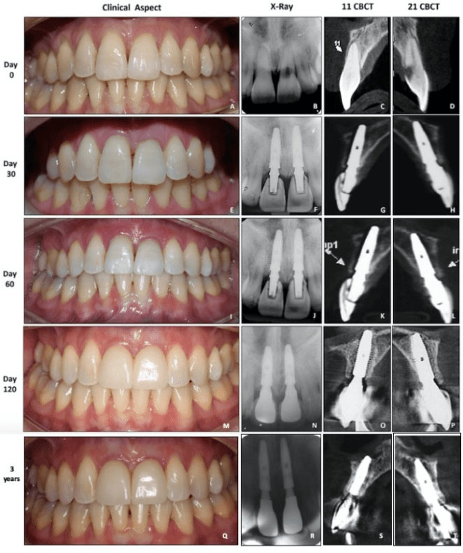 Immediate Implant In The Esthetic Zone: A Three Year Clinical, X-Ray ...