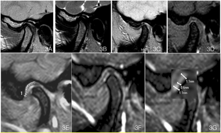 Detection Of The Temporomandibular Joint Fibrocartilage By Magnetic ...