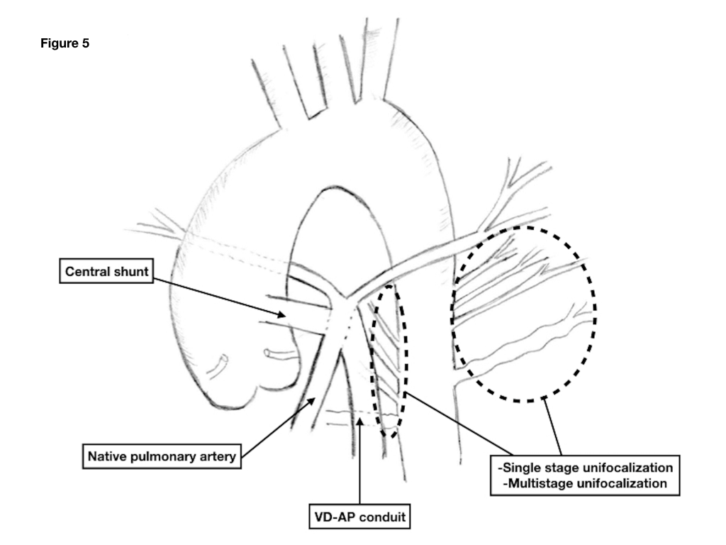 Акцент на легочной артерии
