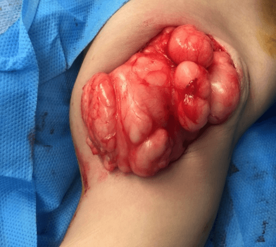 Rare Presentation of Huge Lipoma in the Right Axillary Region in a 10  Months' Infant, Surgery Case Reports, Science Repository