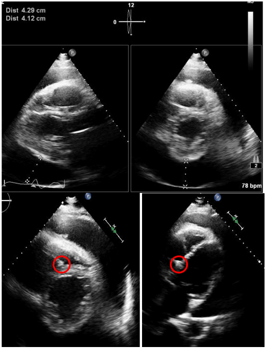 ICDElectrodePerforation of the Right Ventricle to the Pericardium