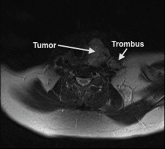 The Clinical Importance Of Tumor Thrombus In Internal