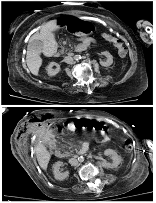 The Cholecystocutaneous Fistula: A Rare Manifestation of Neglected ...