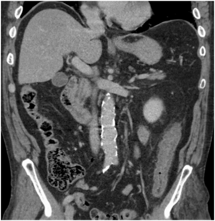 A Case of Colonic Ischaemia Masquerading as a Colonic Mass | Surgical ...