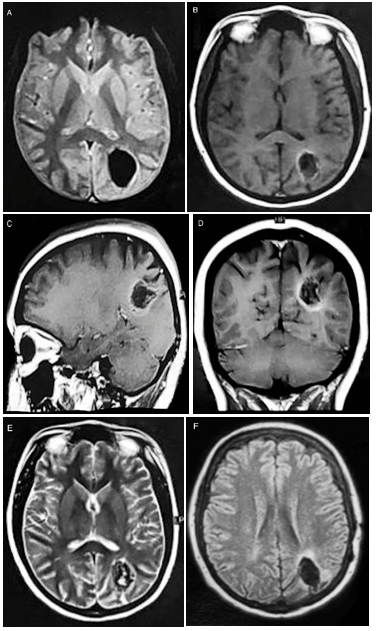 Intracerebral Calcifying Pseudoneoplasm of the Neuroaxis (CAPNON ...