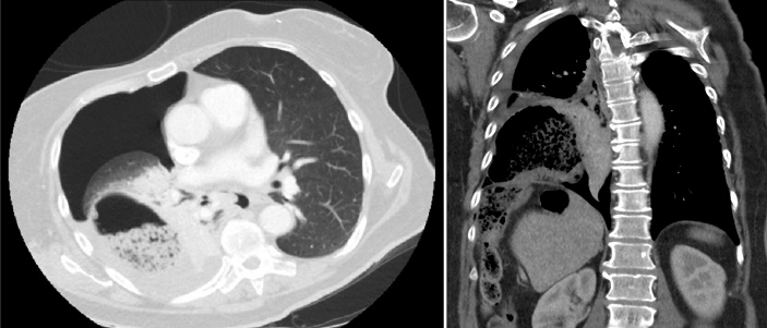 Right-Sided Bochdalek Hernia with Cecum Perforation | Surgical Case ...