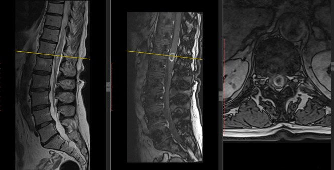 The Role of the Surgery in the Case of an Intramedullary Spinal Cord ...