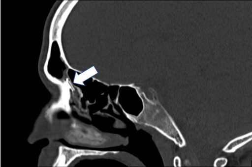 Prolonged Implantation of Sinus Devices and Implications for Chronic ...