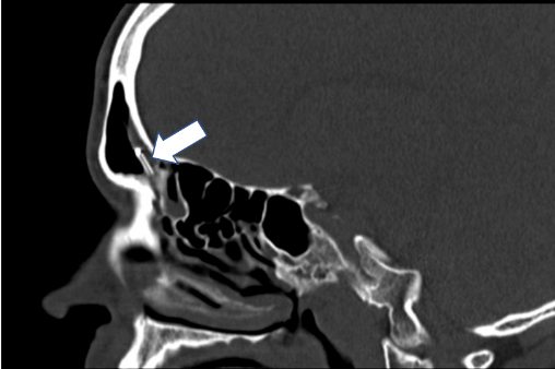 Prolonged Implantation of Sinus Devices and Implications for Chronic ...