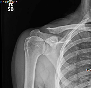 Severe and Rapid Post-Traumatic Osteolysis of the Distal Clavicle in a ...