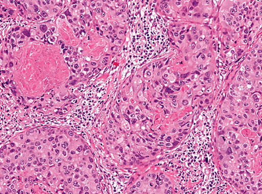 Long-term Recurrence-free Survival After Salivary Duct Carcinoma Of The 