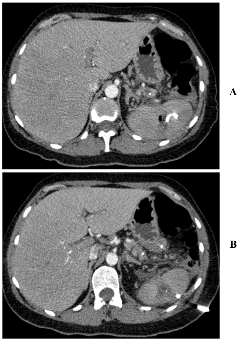 Pancreatogenic Splenic Pseudocysts: Pathogenesis, Diagnosis and ...