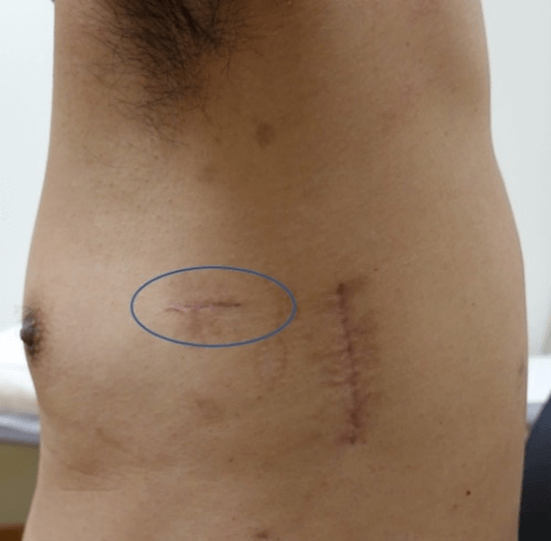 A-C) Post chest tube removal closure technique.
