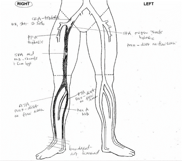 Remote Endarterectomy for an Occluded Superficial Femoral Artery (SFA ...